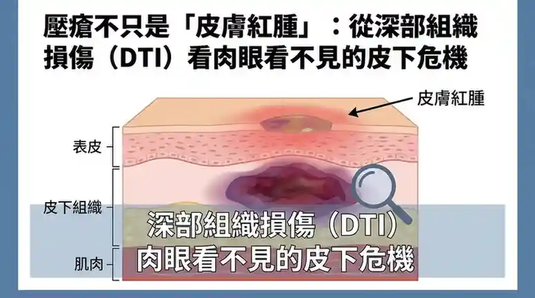 深部組織損傷DTI壓瘡